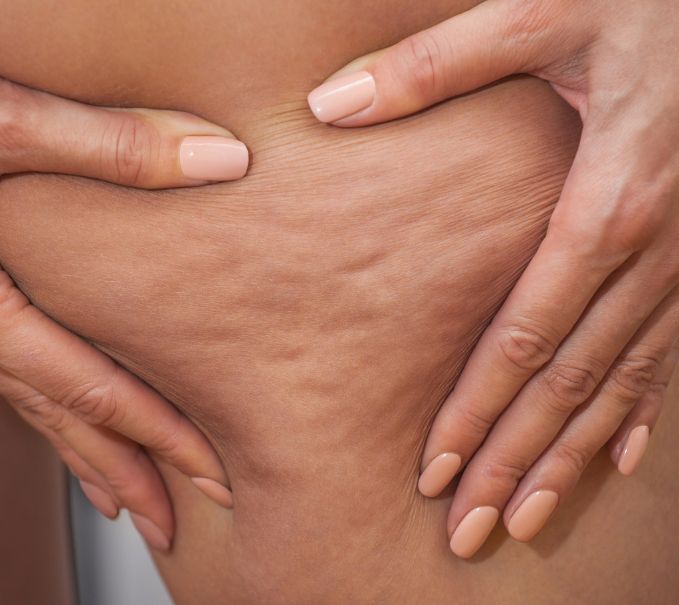 Cellulite : légère ou incrustée, comment les différencier ?